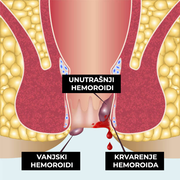 kako zaustaviti krvarenje hemoroida